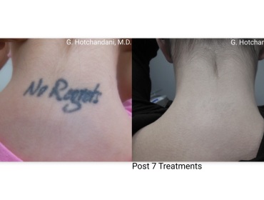 tattoo_removal_before_and_after-19