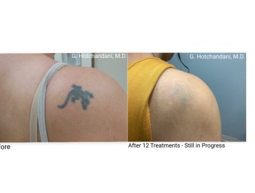 tattoo_removal_before_and_after-2