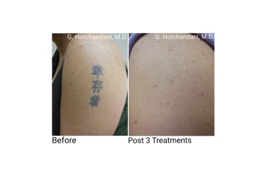 tattoo_removal_before_and_after-20