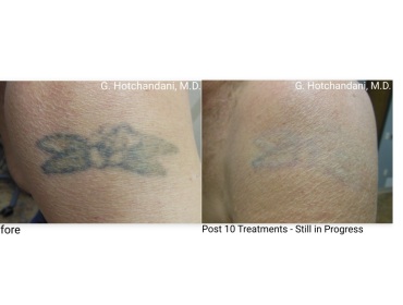 tattoo_removal_before_and_after-21