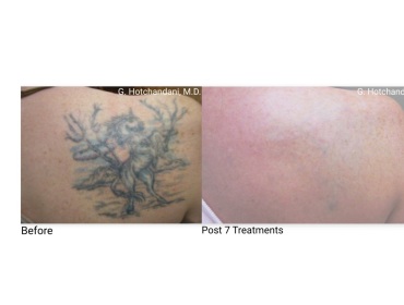 tattoo_removal_before_and_after-22