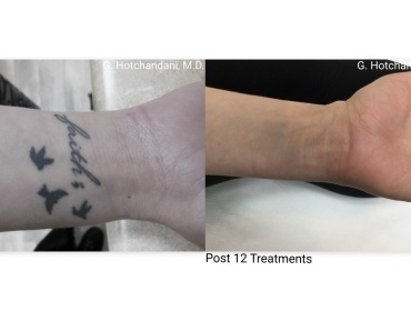 tattoo_removal_before_and_after-23