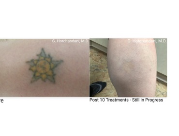 tattoo_removal_before_and_after-24