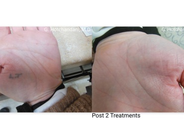 tattoo_removal_before_and_after-3