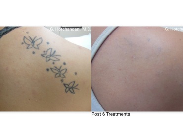 tattoo_removal_before_and_after-4