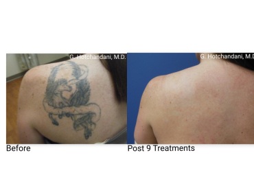 tattoo_removal_before_and_after-5