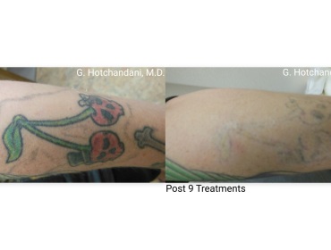 tattoo_removal_before_and_after-6