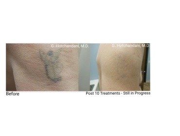 tattoo_removal_before_and_after-7