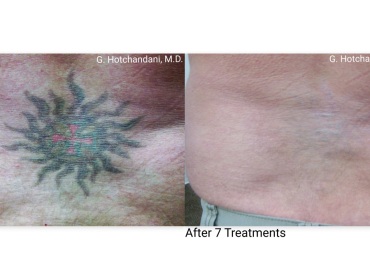 tattoo_removal_before_and_after-8