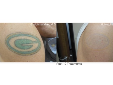 tattoo_removal_before_and_after-9