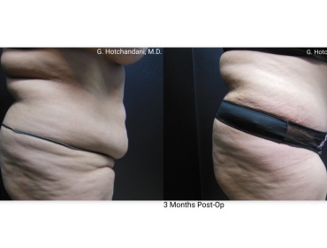 tummy_tuck_before_and_after-1