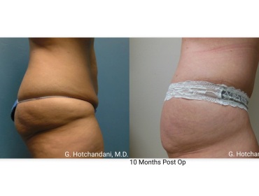 tummy_tuck_before_and_after-12