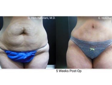 tummy_tuck_before_and_after-13