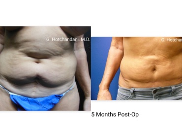 tummy_tuck_before_and_after-15