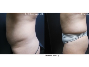 tummy_tuck_before_and_after-16