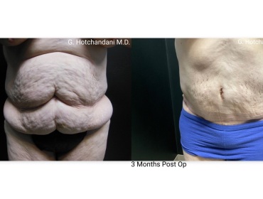tummy_tuck_before_and_after-17