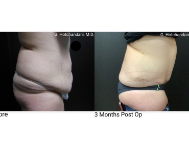 tummy_tuck_before_and_after-20