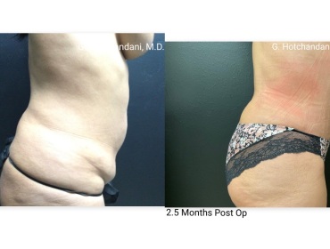tummy_tuck_before_and_after-23