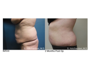 tummy_tuck_before_and_after-24