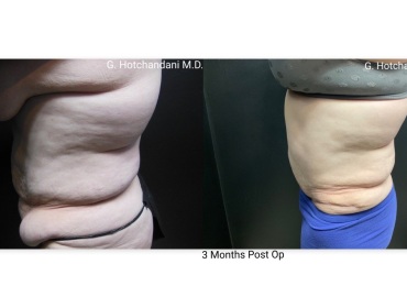 tummy_tuck_before_and_after-26