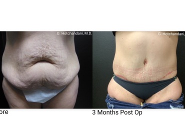 tummy_tuck_before_and_after-27