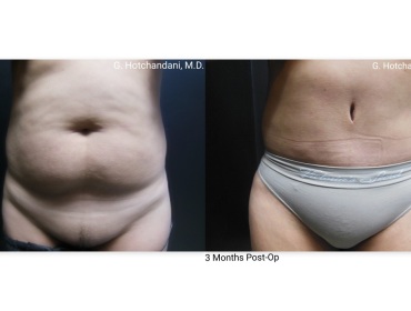 tummy_tuck_before_and_after-29