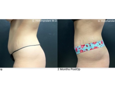 tummy_tuck_before_and_after-3