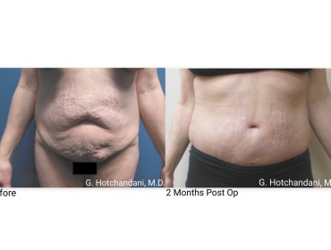 tummy_tuck_before_and_after-4