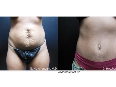 tummy_tuck_before_and_after-6