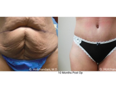 tummy_tuck_before_and_after-7