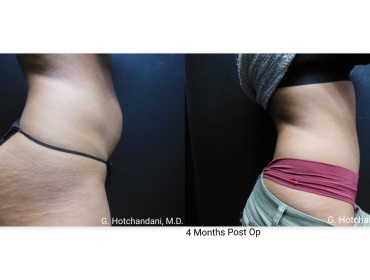 tummy_tuck_before_and_after-8