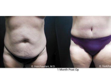 tummy_tuck_before_and_after-9