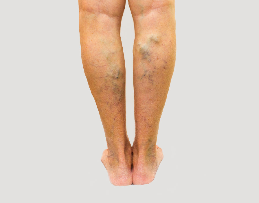 vascular-conditions