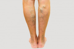Vascular Conditions