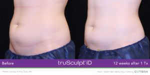 trusculpt abs before and after