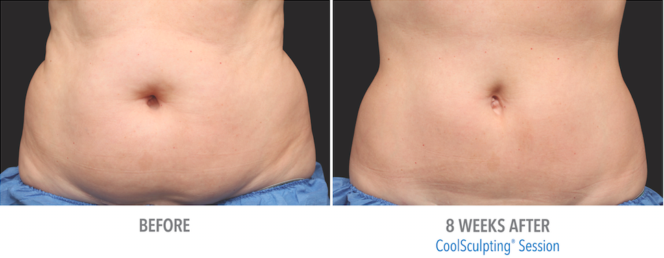 coolsculpt, green bay wi