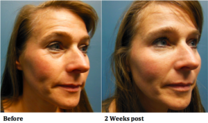 botox treatment before and after