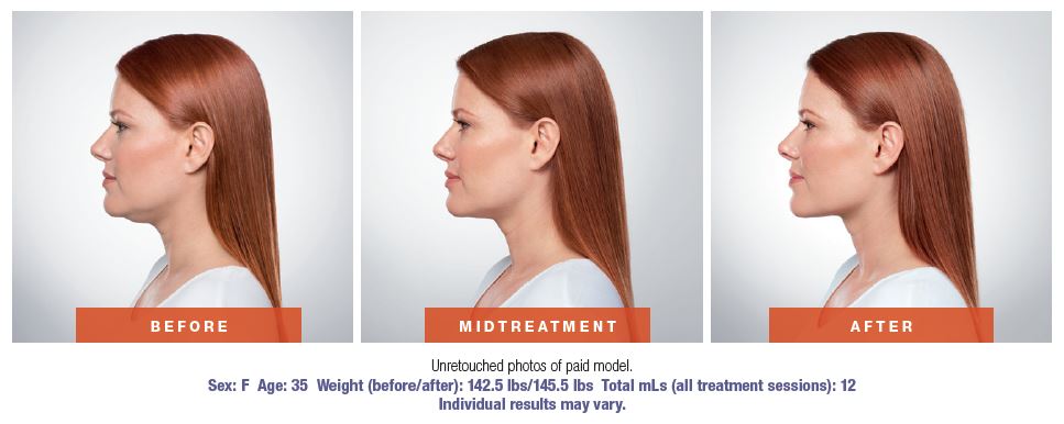 Kybella-Before-and-After-Green Bay WI