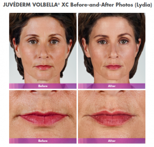 Juvederm Volbella XC adds voluma natural to lips