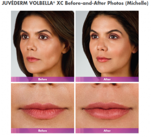 Juvederm Volbella XC smooth lines around mouth