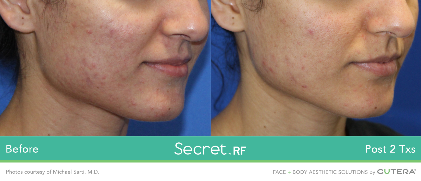 acne scars treatment near me