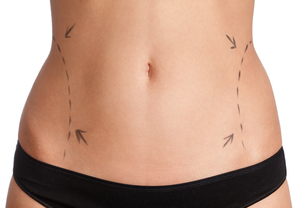 abdomen marked for treatment