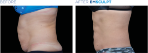 emsculpt 