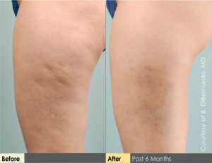 cellulite treatment Green Bay WI