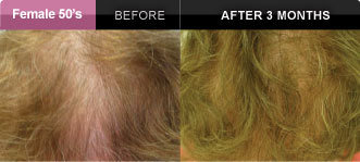 womens hair restoration Wisconsin