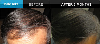 hair restoration Wisconsin