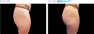 emsculpt butt lifting