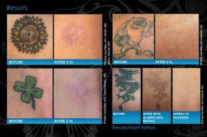 tattoo removal Wisconsin