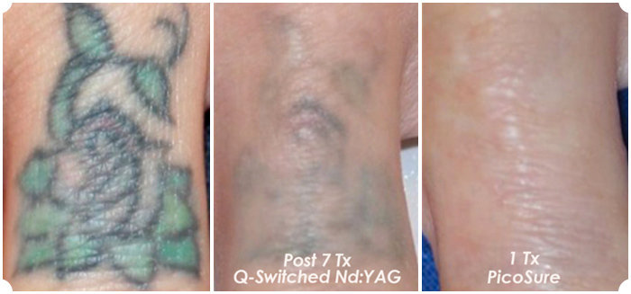 tattoo removal Wisconsin