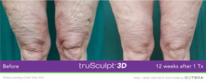 trusculpt leg tightening before and after